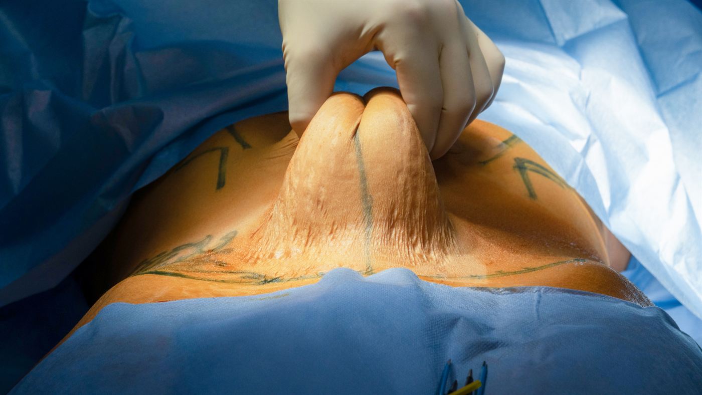 Abdominoplastia — imagem ilustrativa
