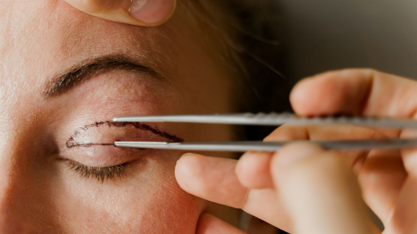 Blefaroplastia — imagem ilustrativa