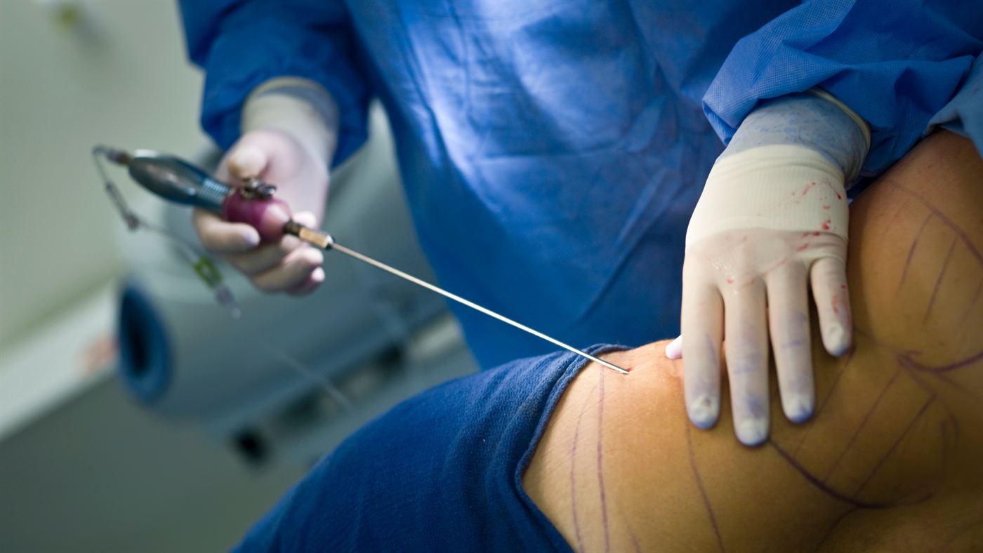 Lipoaspiração — imagem ilustrativa