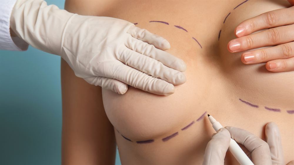 Mamoplastia de aumento — imagem ilustrativa